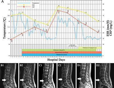 Case Report: Suspected Case of Brucella-Associated Immune Reconstitution Inflammatory Syndrome